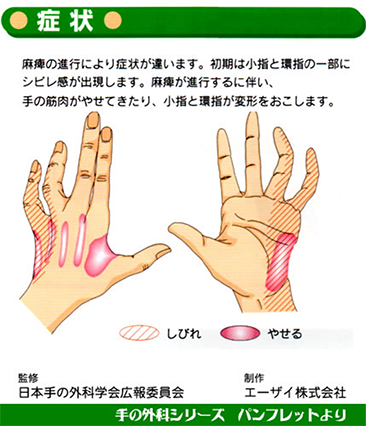 手 腕 肘が痛い方へ 札幌市中央区のいとう整形外科病院
